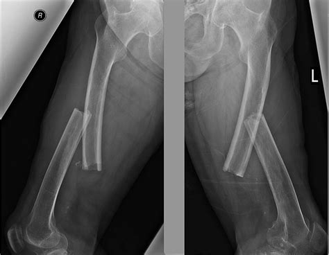 Cureus Open Reduction And Internal Fixation Of Simultaneous