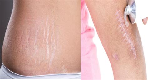 Stretch Marks Scars Removal Naturally At Home Solution Hacks Jmp