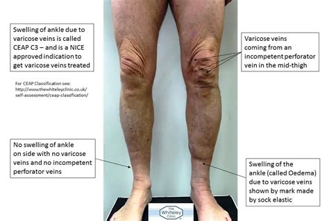 What Causes Swelling In Legs