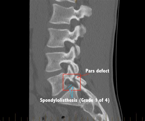 Spondylolisthesis Image Cns Neurosurgery