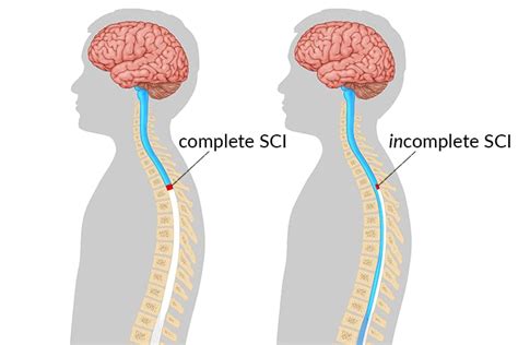 Complete Vs Incomplete Spinal Cord Injury Whats Different