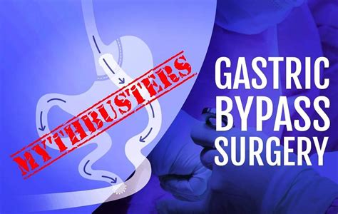 8 Facts About Gastric Bypass Surgery Gastric Bypass Myth Busters Gastric Bypass Gastric