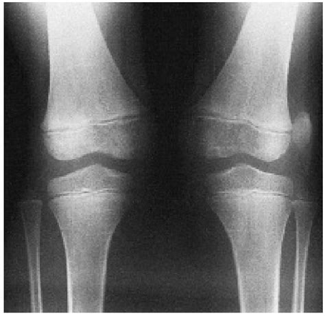 Intra Articular Injuries Of The Knee Teachme Orthopedics