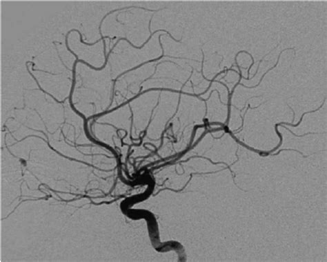Traumatic Pseudoaneurysm Lateral Digital Subtraction Angiography