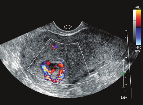 Color Doppler Ultrasound Of The Uterus Heterogenous Material With