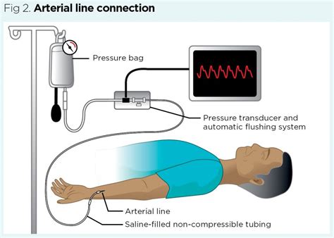 Essential Critical Care Skills 3 Arterial Line Care Nursing Times