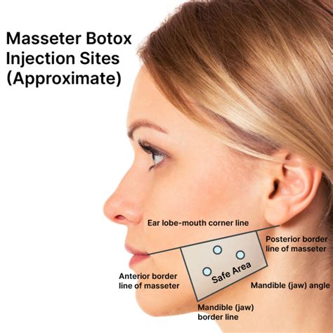 Masseter Botox Botox For Tmj Botox For Migraines Info Cost