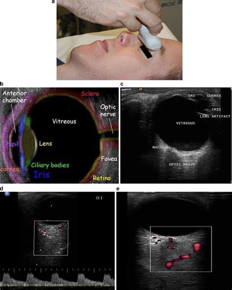 Role Of B Scan Ocular Ultrasound As An Adjuvant For The Clinical