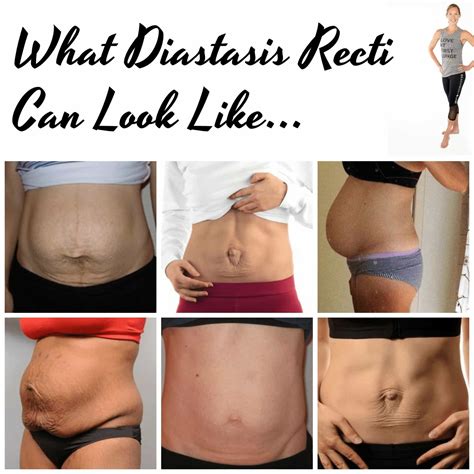 Eat a balanced diet.most women gain weight during a healthy pregnancy, but obesity is a risk factor for varicose veins—so try to stay within the recommended range of weight gain by eating nutritious foods. Learn How to Recover Abdominal Diastasis after Pregnancy ...