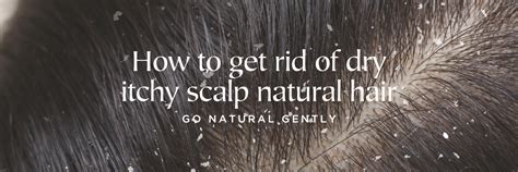 How To Get Rid Of Dry Itchy Scalp Natural Hair — Sade Baron Inc