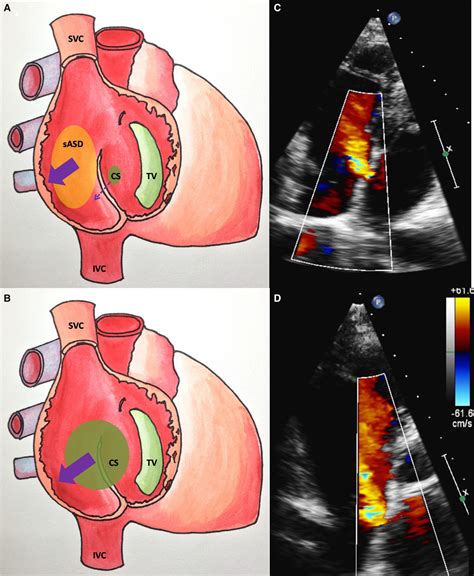 Mimic Of Atrial Septal Defect Circulation Cardiovascular Imaging