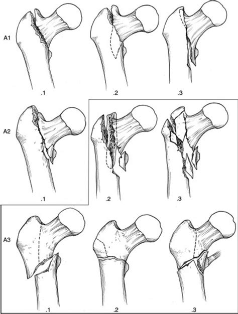 Arthroplasty For Pertrochanteric Hip Fractures Orthopedic Clinics