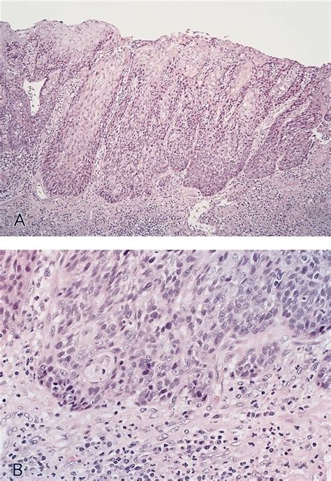 Pathology Outlines Squamous Dysplasia