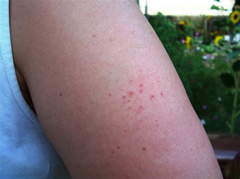 Blood Spots On Arms All In One Photos