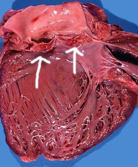Miocarditis crónica, eran de etiología chagásica, es decir, que el t cruzi era el en los últimos diez años, han sido pocos los casos de miocarditis chagásica diagnosticados en autopsias y menos aún. USMLE - LIBMAN-SACKS ENDOCARDITIS http://www.score95.com ...