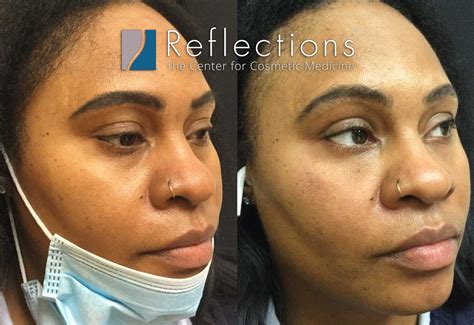 Under Eye Filler With Cheek Support Pre Treatment With Filler Before