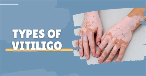 Types Of Vitiligo Vitiligo Treatment