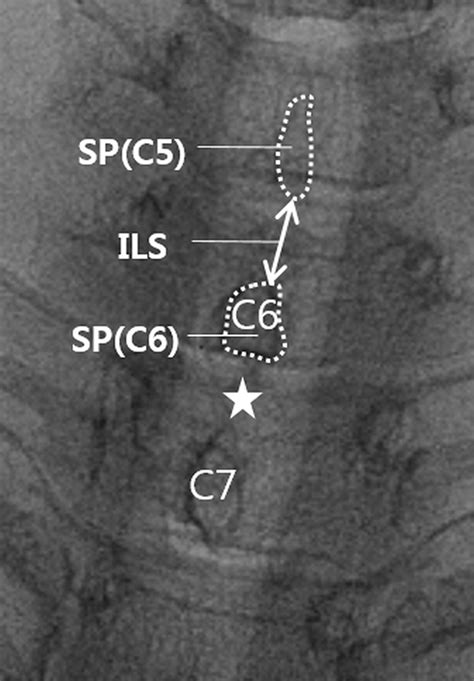 Fluoroscopically Guided Epidural Injections Of The Cervical And Lumbar