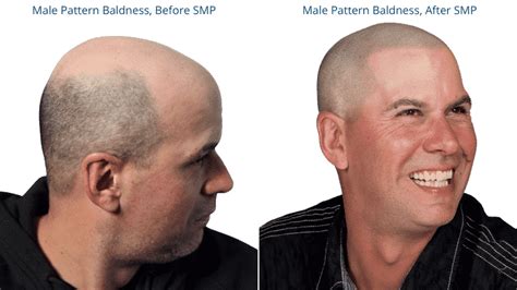 Horseshoe Pattern Baldness