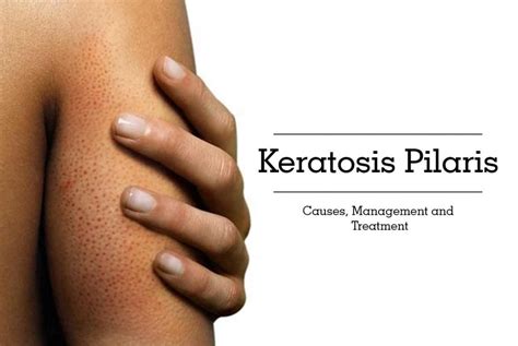 Keratosis Pilaris Everything You Should Know About It Dr Kashif S Aesthetic Studio