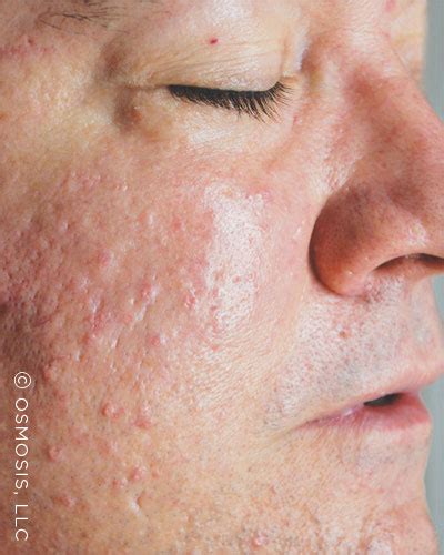 Sebaceous Hyperplasia Skincare Product Solutions