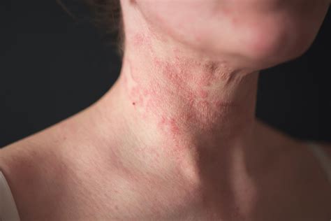 Finding Relief For Severe Eczema