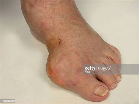 Gout Leg Photos And Premium High Res Pictures Getty Images