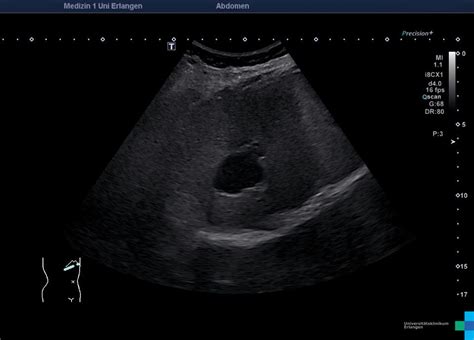 Complex Liver Cyst Series Of Images Atlas Of Ultrasound