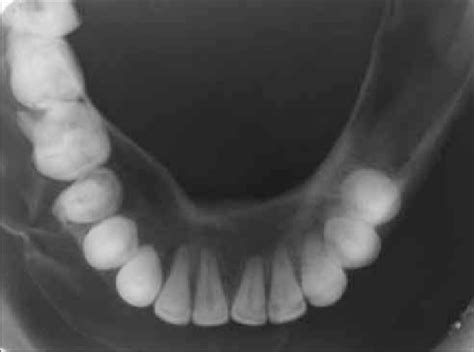 Case 2 Mandibular Occlusal Radiograph With Buccal And Lingual Cortical