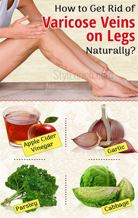 How To Get Rid Of Varicose Veins On Legs Naturally Healthy Food Vision