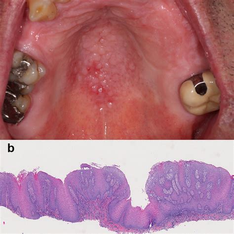 The Hairy Appearance Of The Posterior Dorsal Surface Of The Tongue Is