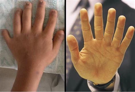 Humans With Six Fingered Hands Can Extend Their Skills And Abilities