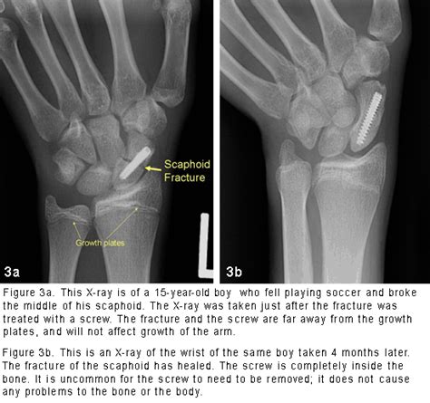 Scaphoid Wrist Bone Fracture Orthopedic Specialists Of Seattle