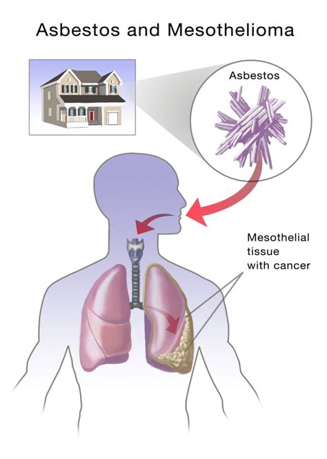 Asbestos And Mesothelioma Poster Print By Spencer Suttonscience Source
