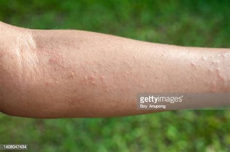 Red Rash Arm Imagens E Fotografias De Stock Getty Images
