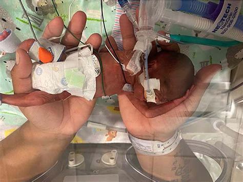 Premature Baby Born At 21 Weeks Is The Youngest Ever To Survive Look