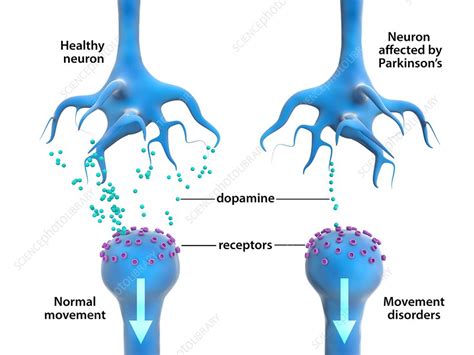 Parkinsons Disease Neurons And Dopamine Stock Image C0303214