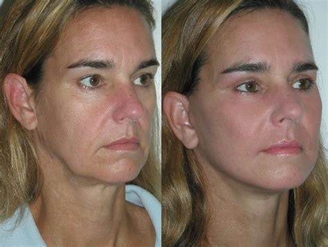 Non Invasive Facelifts And Yoga Facial Exercises Remedy Flaccid Jowls