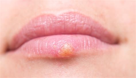 Herpes Labial O Que Sintomas Causas E Tratamento Tua Sa De Hot Sex Picture