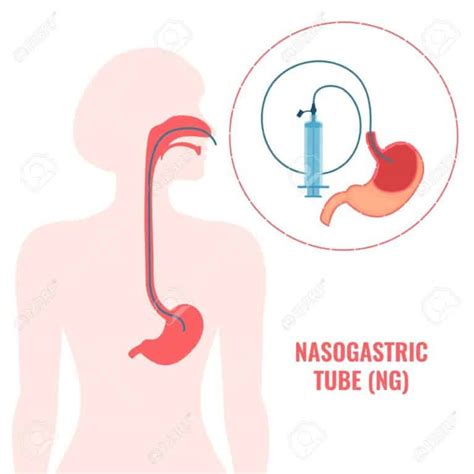 Ventajas Y Desventajas De La Sonda Nasogastrica Proscont Hot Sex Picture