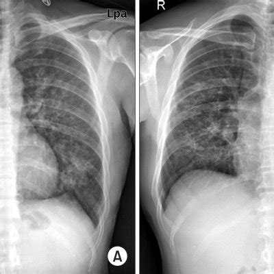 A B Transbronchial Lung Biopsy Specimen Reveals Organizing Pattern