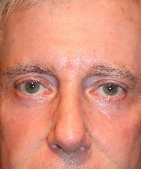 Before And After Gallery Laser Assisted Oculofacial Surgery
