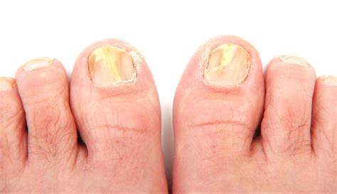 Top 11 Toenail Fungus Natural Treatments Using Home Remedy