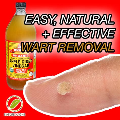 Pin By Kira Dent On Beauty Home Remedies For Warts Warts Remedy