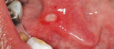 Canker Sore On Uvula Pregnant Center Informations