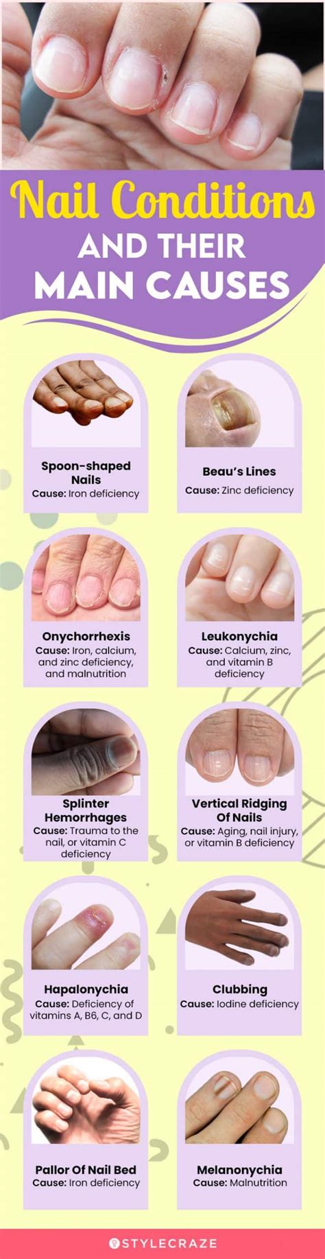 Effects Of Nutrient Deficiency On The Nails What Do They Indicate