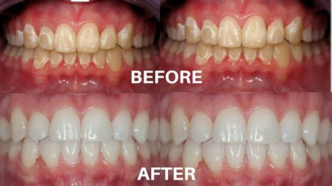 Dont Go To The Dentist Remove White Spots On Your Teeth At Home