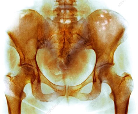 Symptoms of bone cancer in dogs. Bone marrow cancer, X-ray - Stock Image - C020/7256 ...