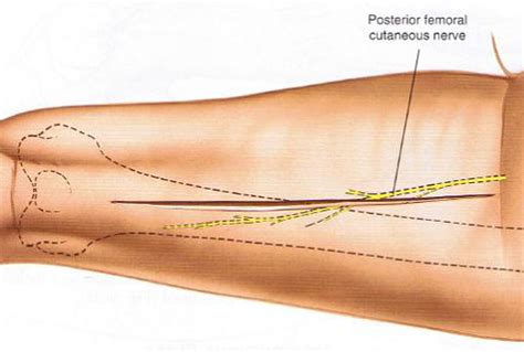 Posterior Approach To Femur Approaches Orthobullets