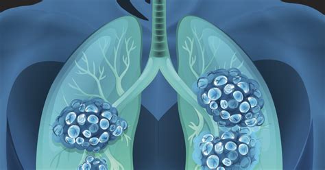 What Are The Chances A Lung Nodule Or Spot Is Cancer Cleveland Clinic